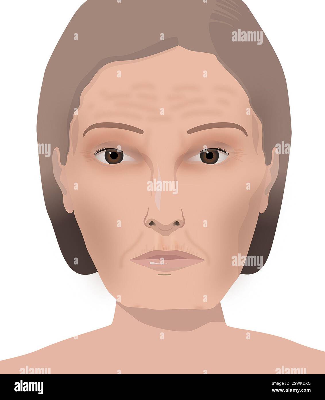 I pazienti che assumono Ozempic spesso sviluppano quello che viene comunemente chiamato "viso Ozempic". Questa condizione si verifica anche con altri farmaci per la perdita di peso, come Wegovy (semaglutide), Mounjaro (tripeptide), e liraglutide (Saxenda). Può includere rughe della fronte e degli occhi, occhi affondati, templi scavati e zigomi, pieghe facciali più profonde, pelle rilassata e sciolta. Foto Stock