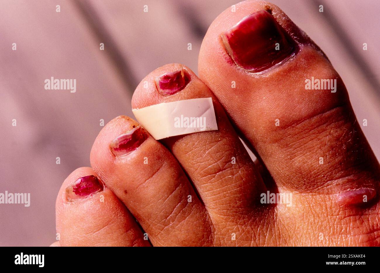 Intonaco sul dito del piede Foto Stock