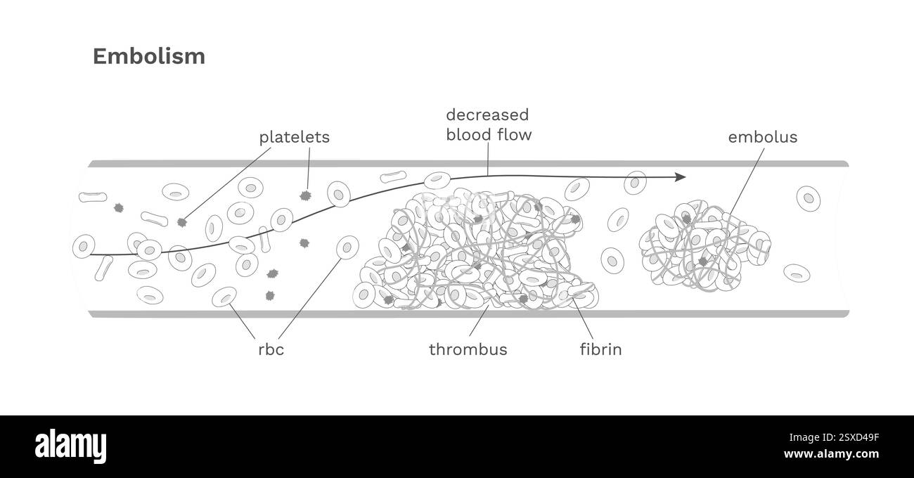 Schema della cartella clinica dell'embolia. Movimento del coagulo nel vaso sanguigno Illustrazione Vettoriale