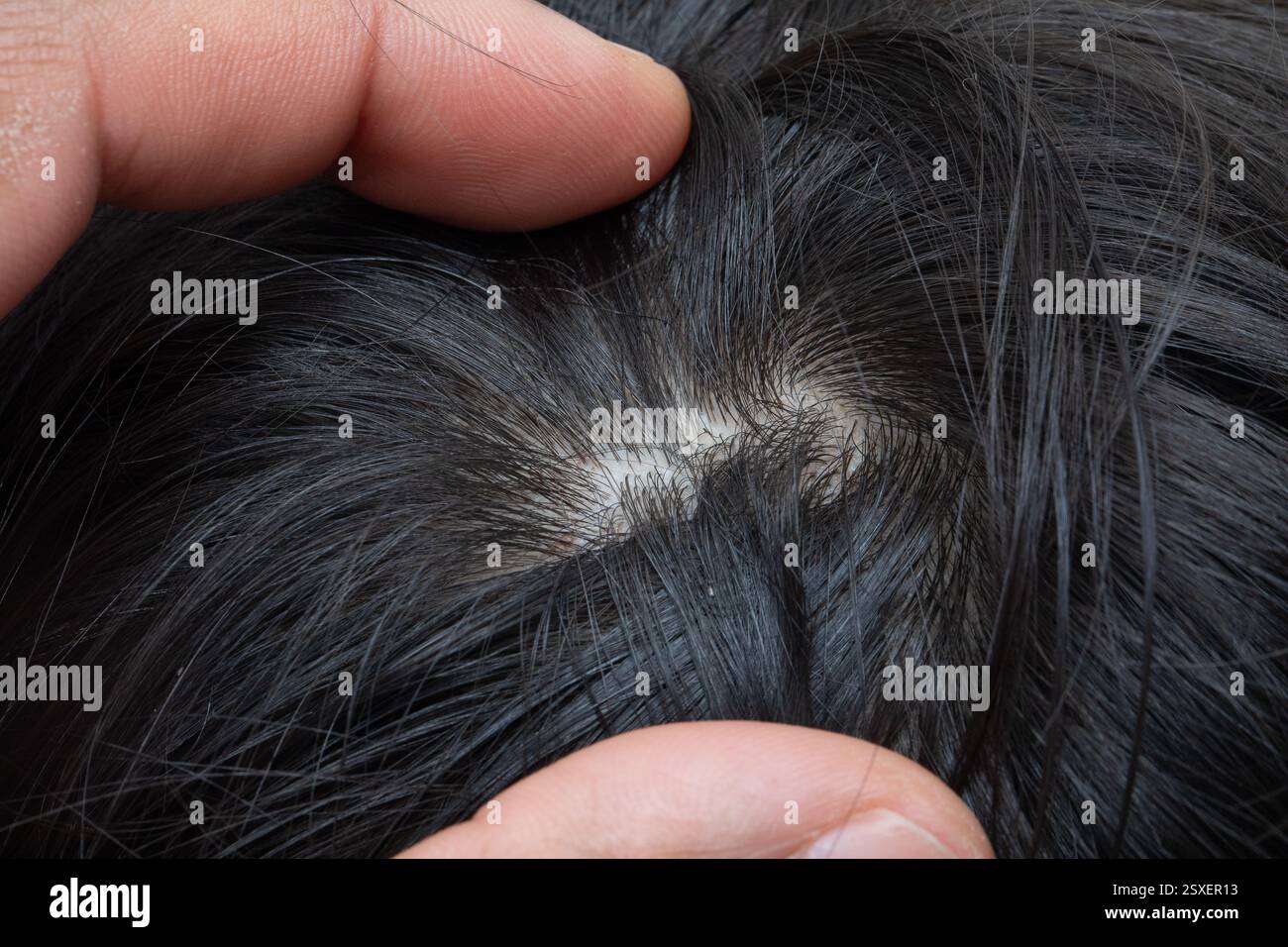 Primo piano di un medico che esamina il cuoio capelluto di un paziente, controlla la perdita di capelli, cerotti calvi e potenziali segni di alopecia Foto Stock