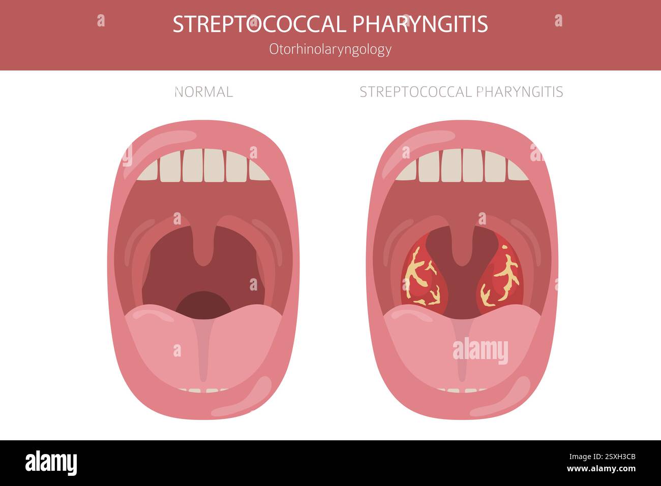 Tonsille e malattie della gola. Faringite streptococcica. Progettazione infografica medica. Illustrazione vettoriale Illustrazione Vettoriale
