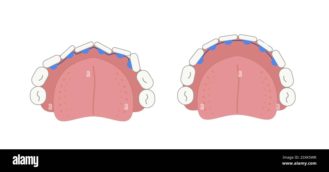 Bretelle linguali nella bocca sulla superficie interna del dente prima e dopo il grafico. Immagine geometrica semplice e piatta. Illustrazione Vettoriale