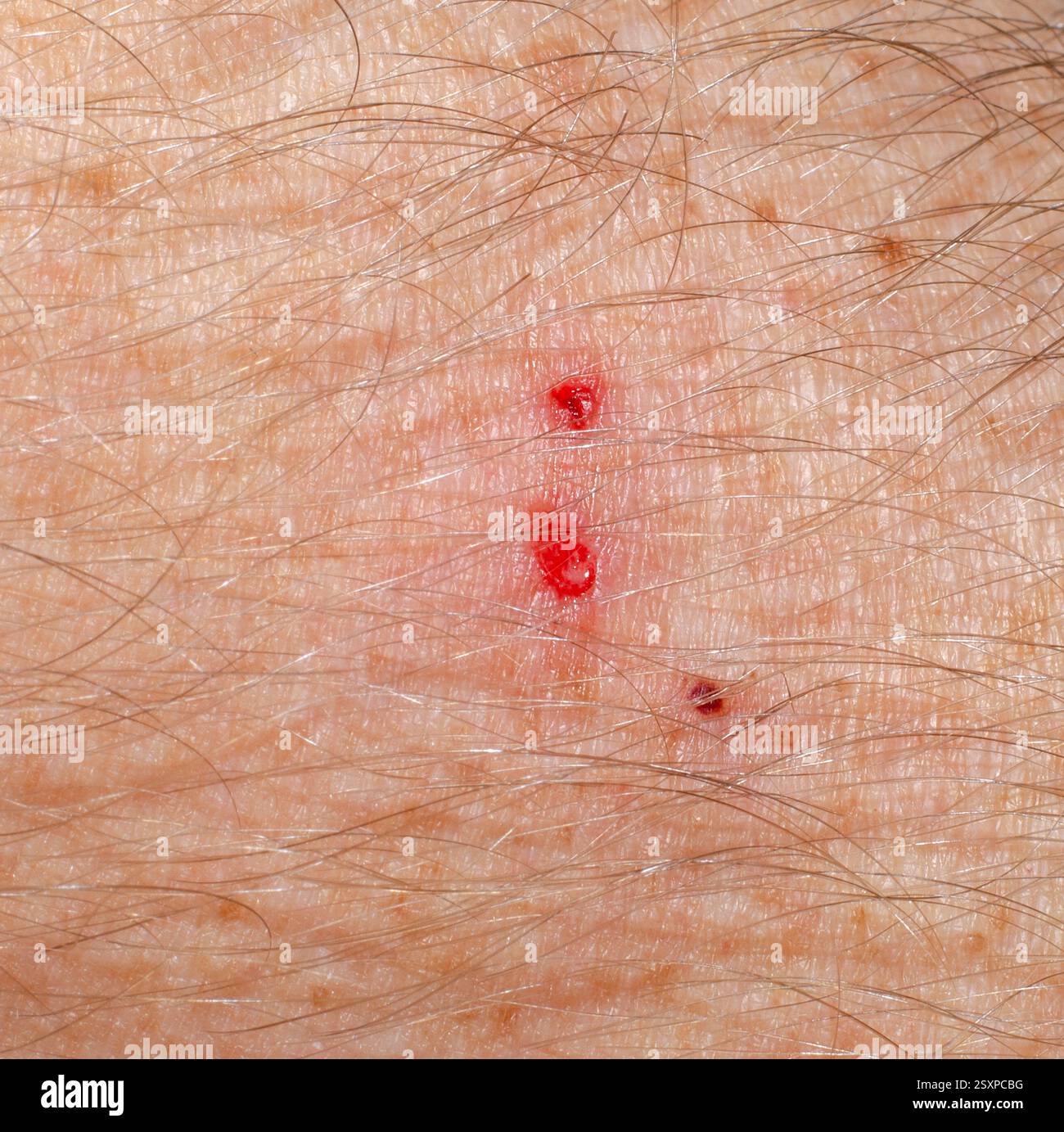 Primo piano di una ferita di morso di serpente sulla pelle umana Foto Stock