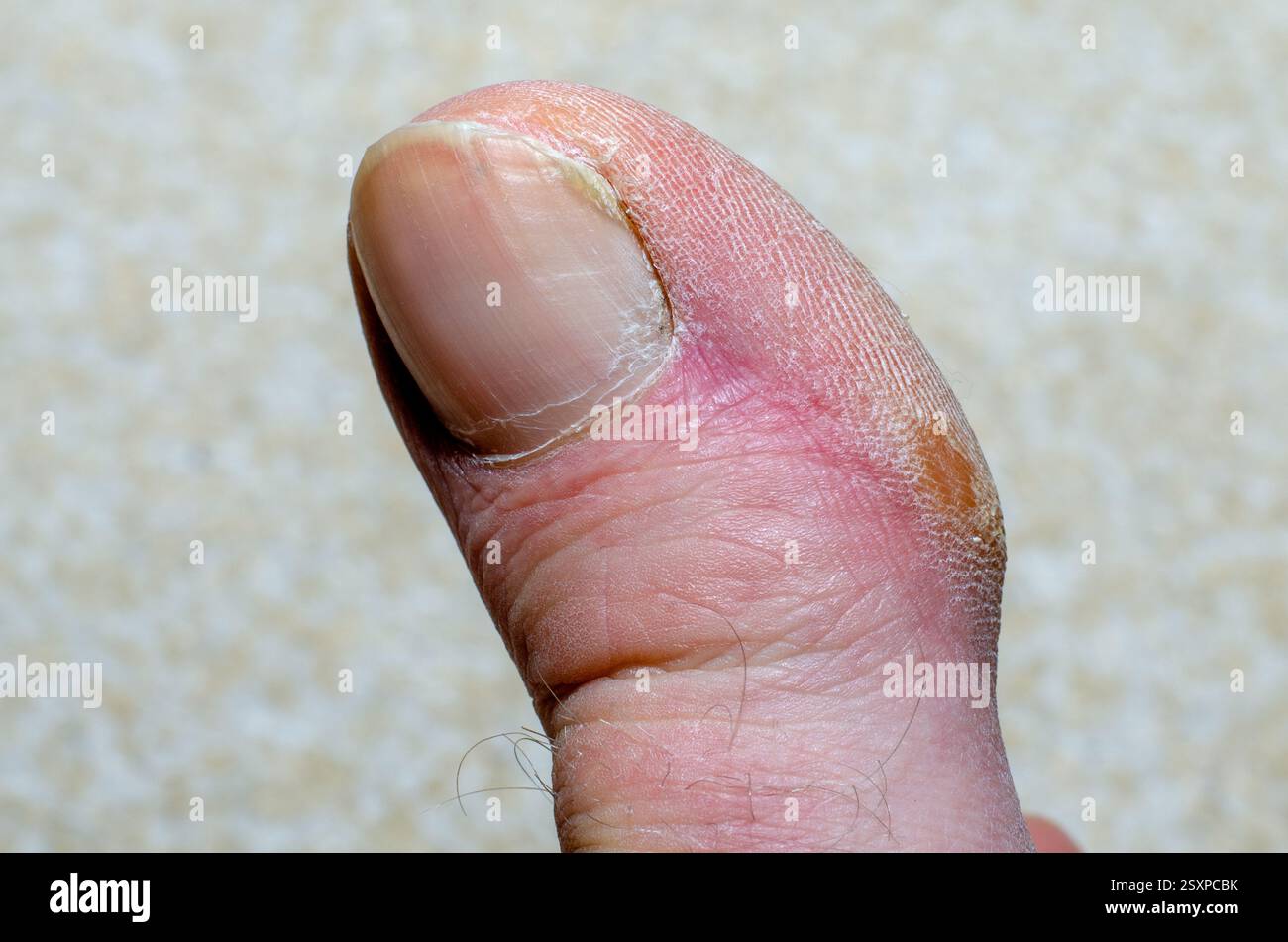 Macro di un pollice umano con texture cutanea Ключевые слова: Macro fotografia, pollice, texture della pelle, primo piano, dito umano, unghie, pelle secca, dermatologia, Foto Stock