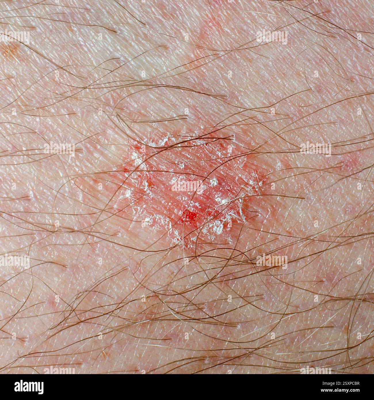 Lesione cutanea con scala e rossore Foto Stock