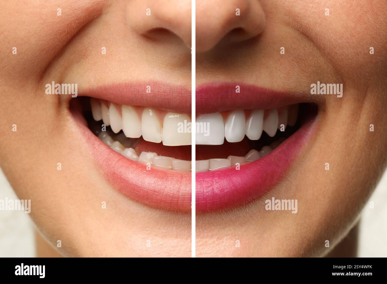 Donna sorridente prima e dopo l'intervento dentistico impiallacciatura posizionamento, primo piano. Miglioramento estetico dei denti, collage Foto Stock