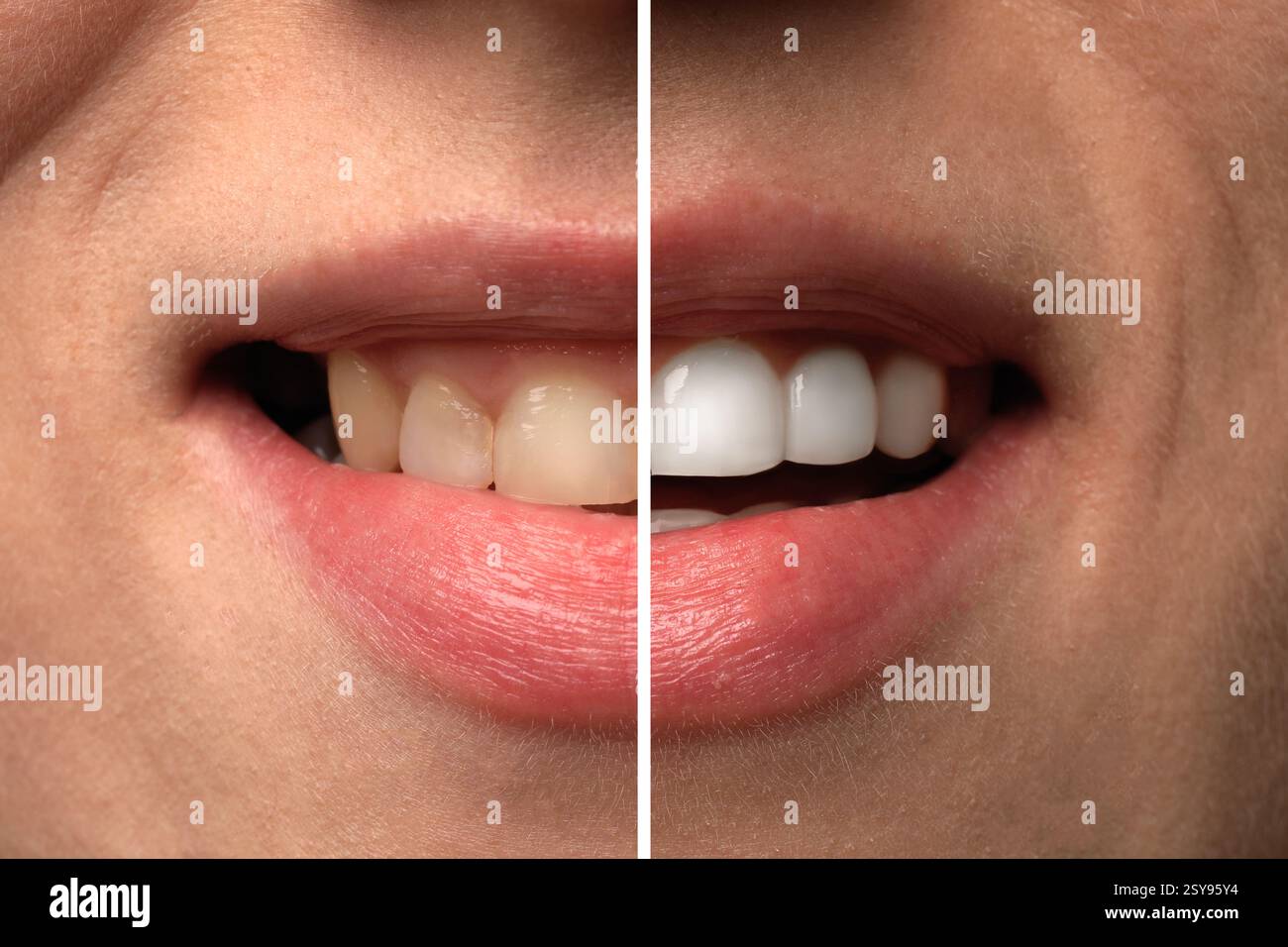 Donna sorridente prima e dopo l'intervento dentistico impiallacciatura posizionamento, primo piano. Miglioramento estetico dei denti, collage Foto Stock