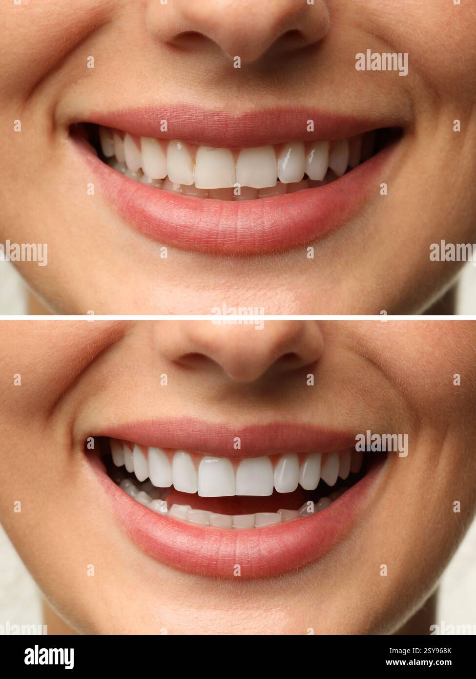 Donna sorridente prima e dopo l'intervento dentistico impiallacciatura posizionamento, primo piano. Miglioramento estetico dei denti, collage Foto Stock