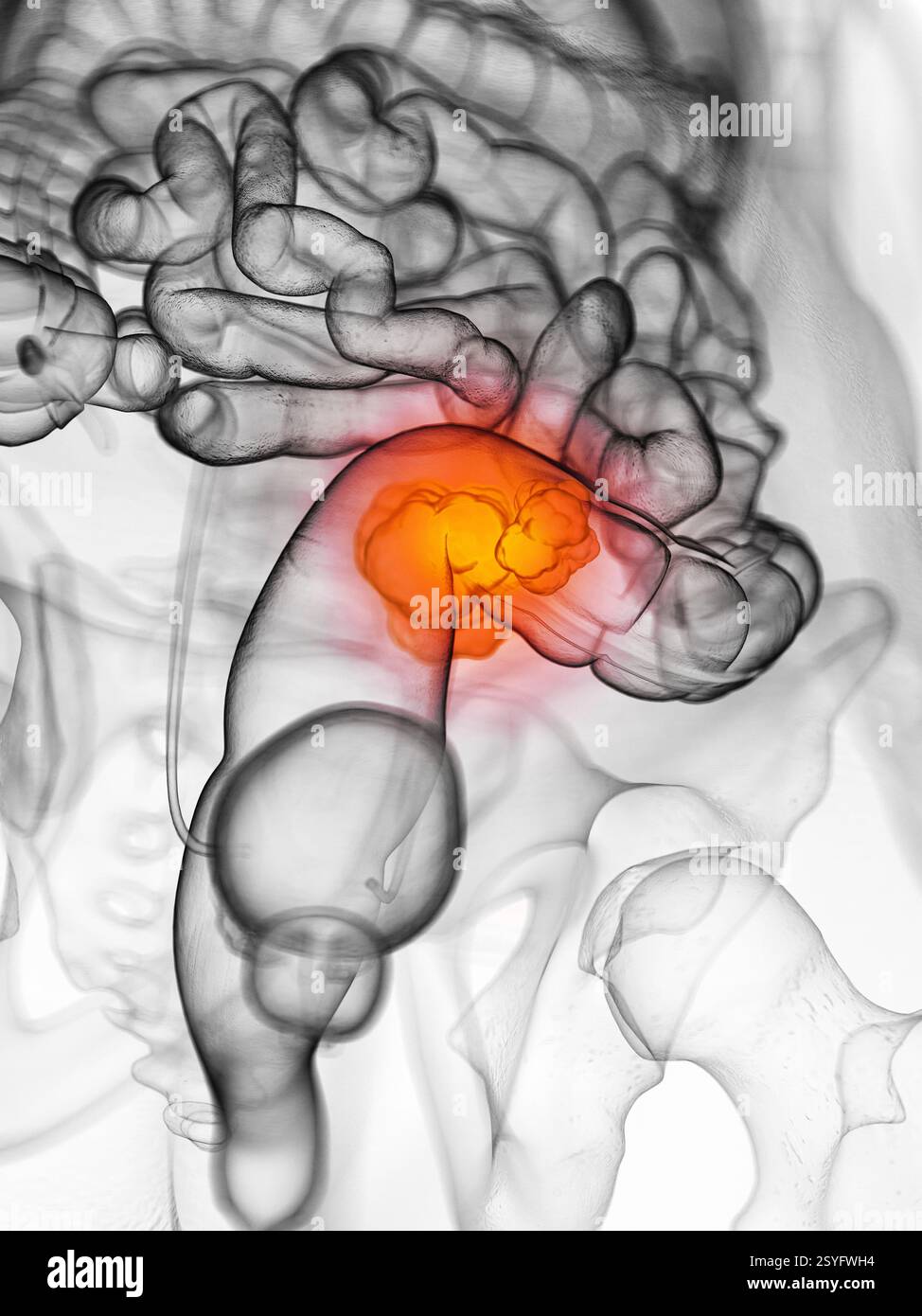 Cancro colorettale, illustrazione. Foto Stock