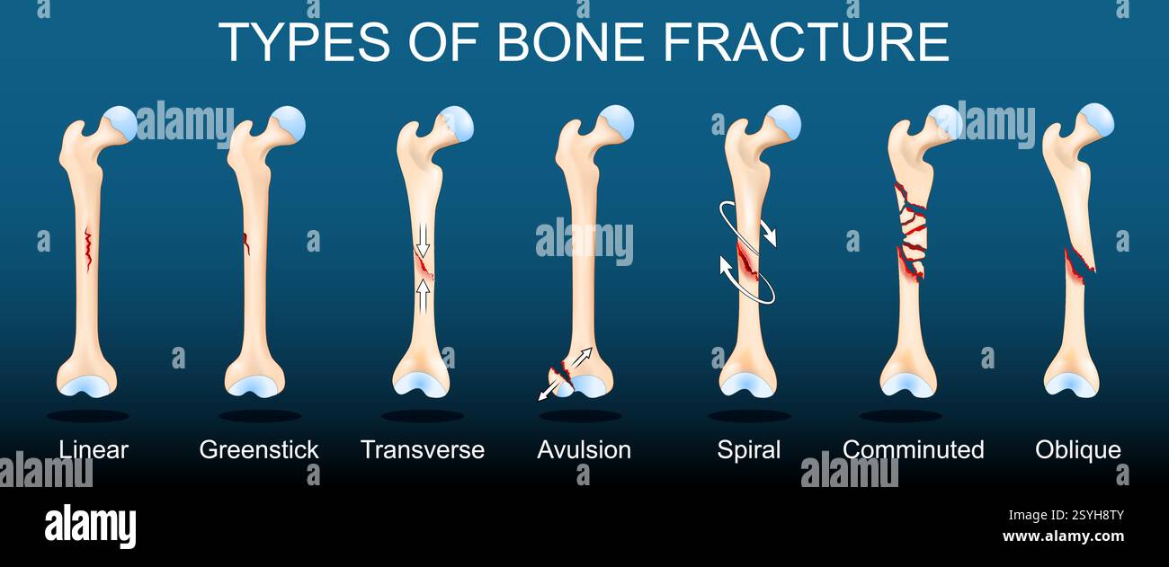 Tipi di frattura ossea. Femori umani rotti su sfondo scuro. Illustrazione vettoriale. Illustrazione Vettoriale