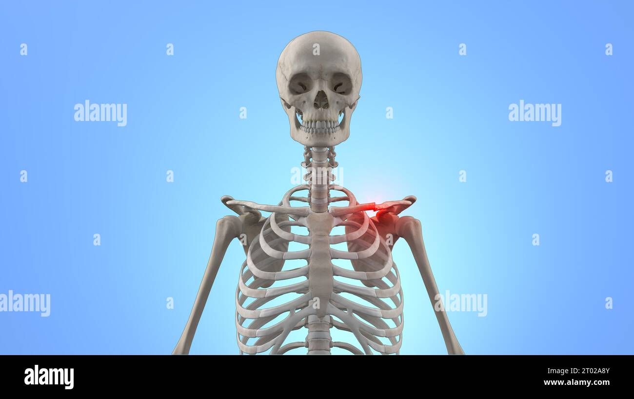 Illustrazione medica 3D di scheletro umano con clavicola rotta Foto Stock