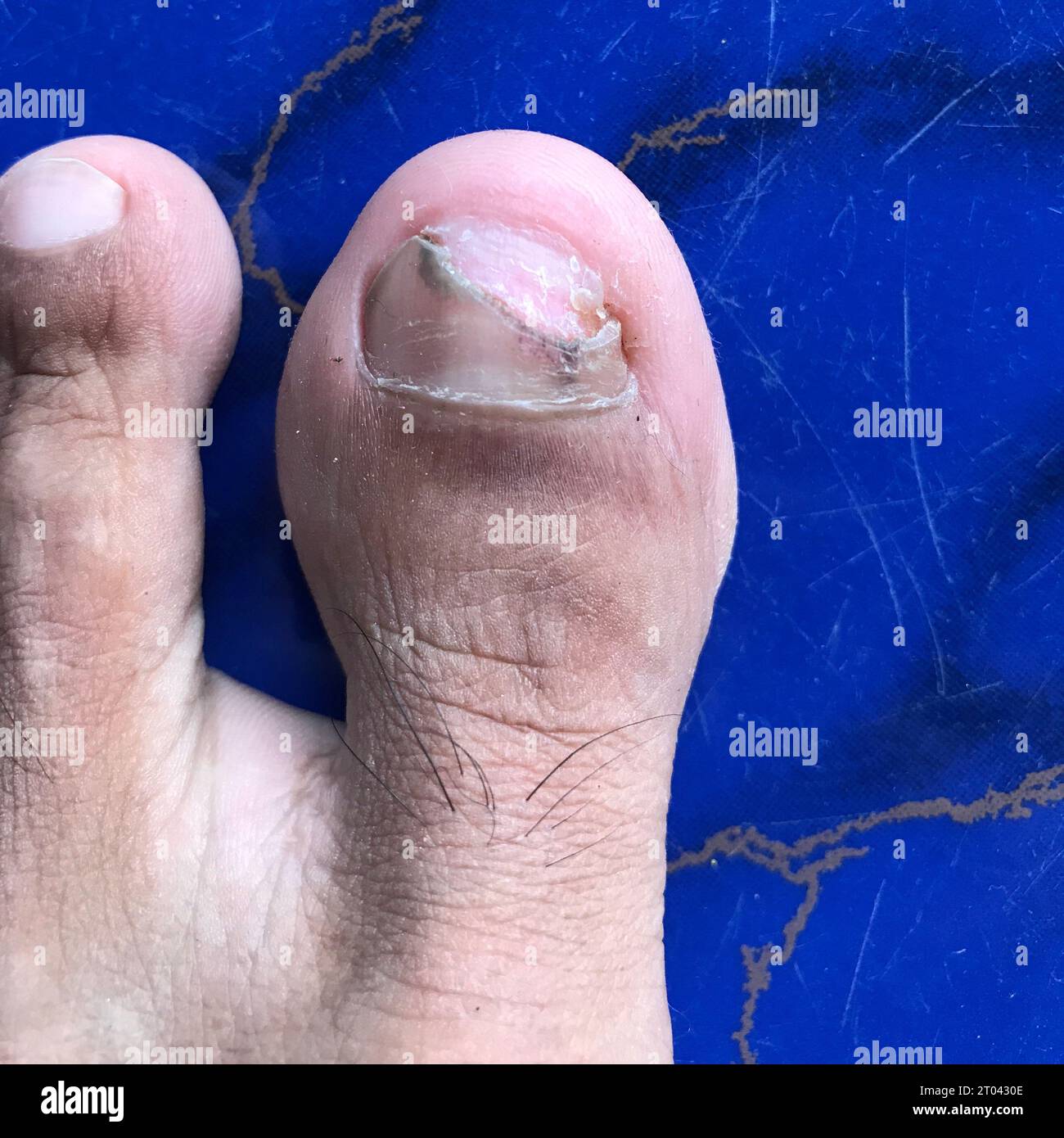 Chiodo del pollice rotto a causa dell'ingresso di sporcizia e sabbia Foto Stock
