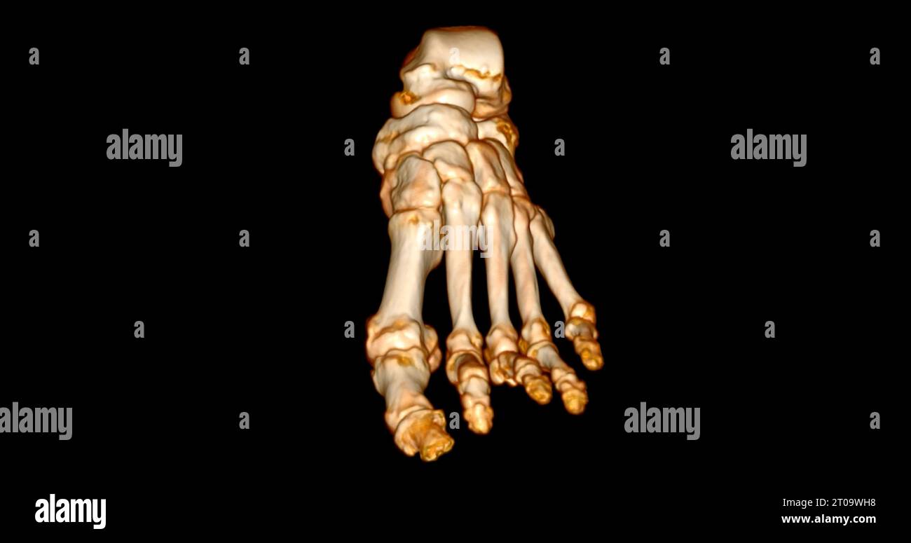 Foot 3D Scan for diagnosis foot diseases by CT-SCANNER . Foto Stock