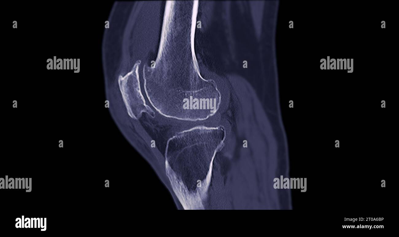 CT Scan dell'articolazione del ginocchio per background medico . Foto Stock