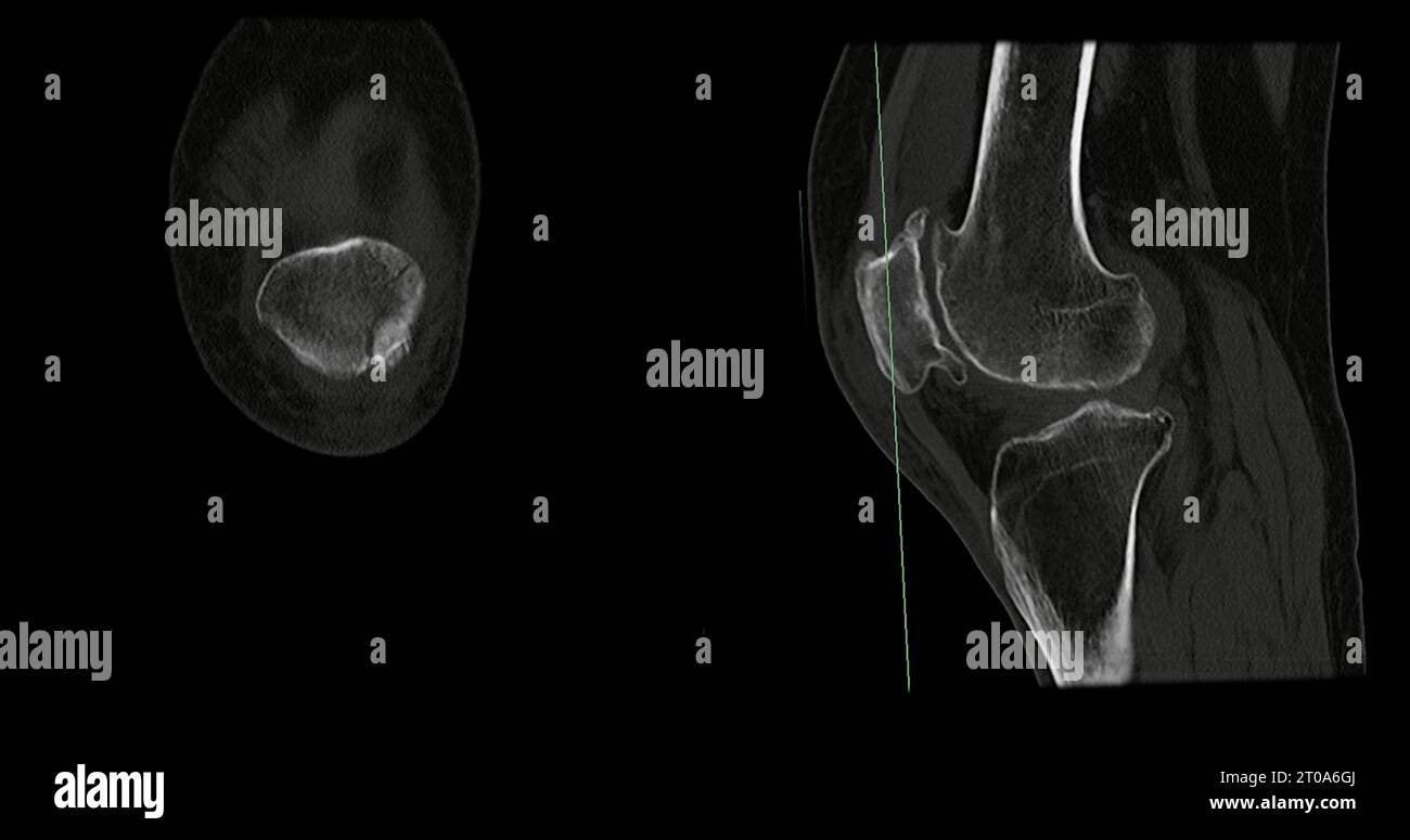 Scansione TC dell'articolazione del ginocchio sagittale e coronale in caso di frattura dell'osso della rotula. Foto Stock