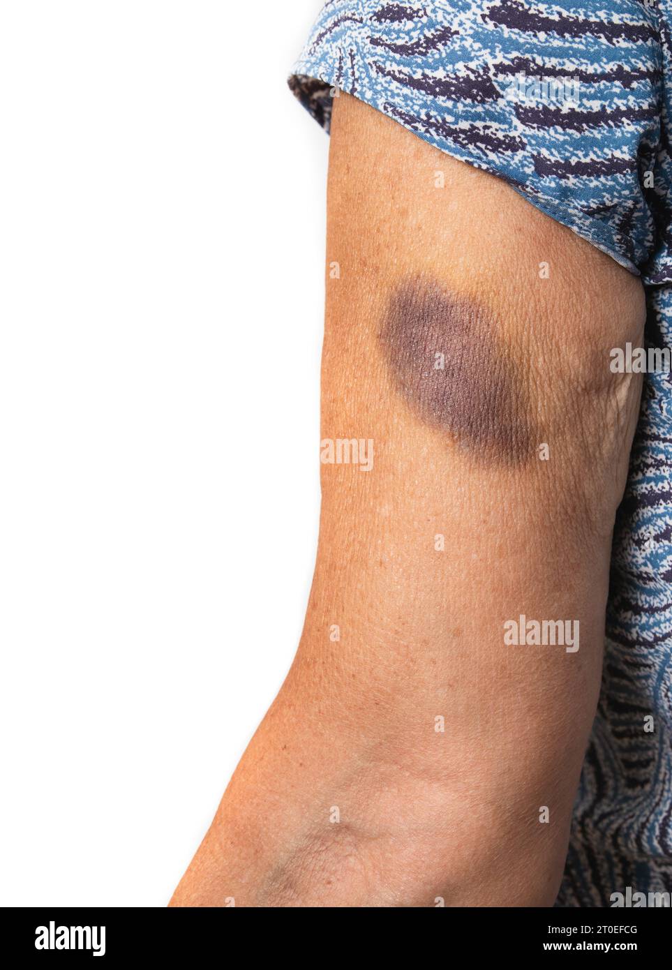 Braccio senior con lividi. Donna con grandi segni blu e viola dovuti a caduta o incidente. O contusioni per motivi medici come fluidificante del sangue, vita Foto Stock