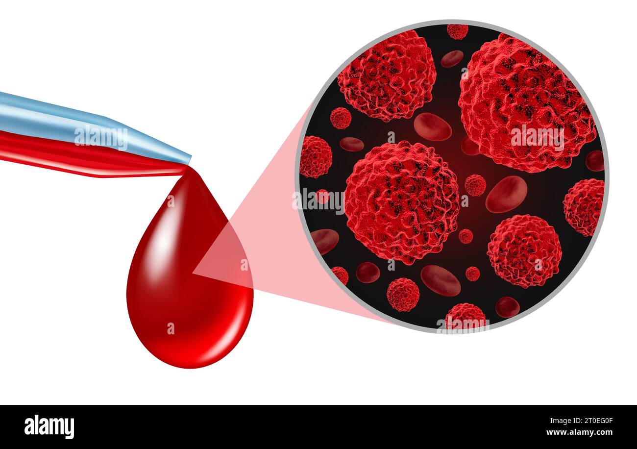 Test di screening del cancro del sangue come diagnosi medica oncologica per marcatori tumorali come biopsia liquida per la diagnosi precoce con cellule maligne . Foto Stock