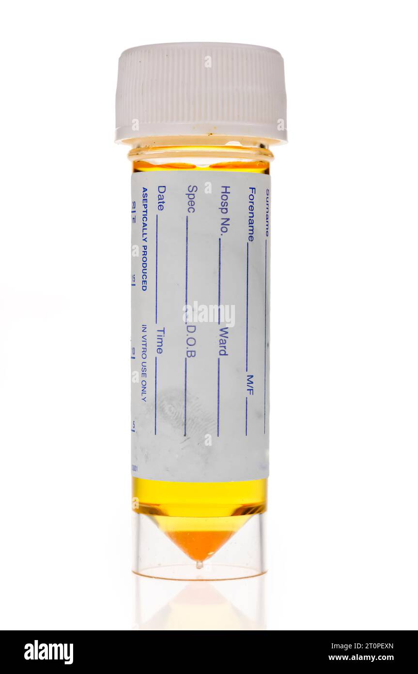 Campione di urina in un chiaro, plastica flacone per campione Foto Stock