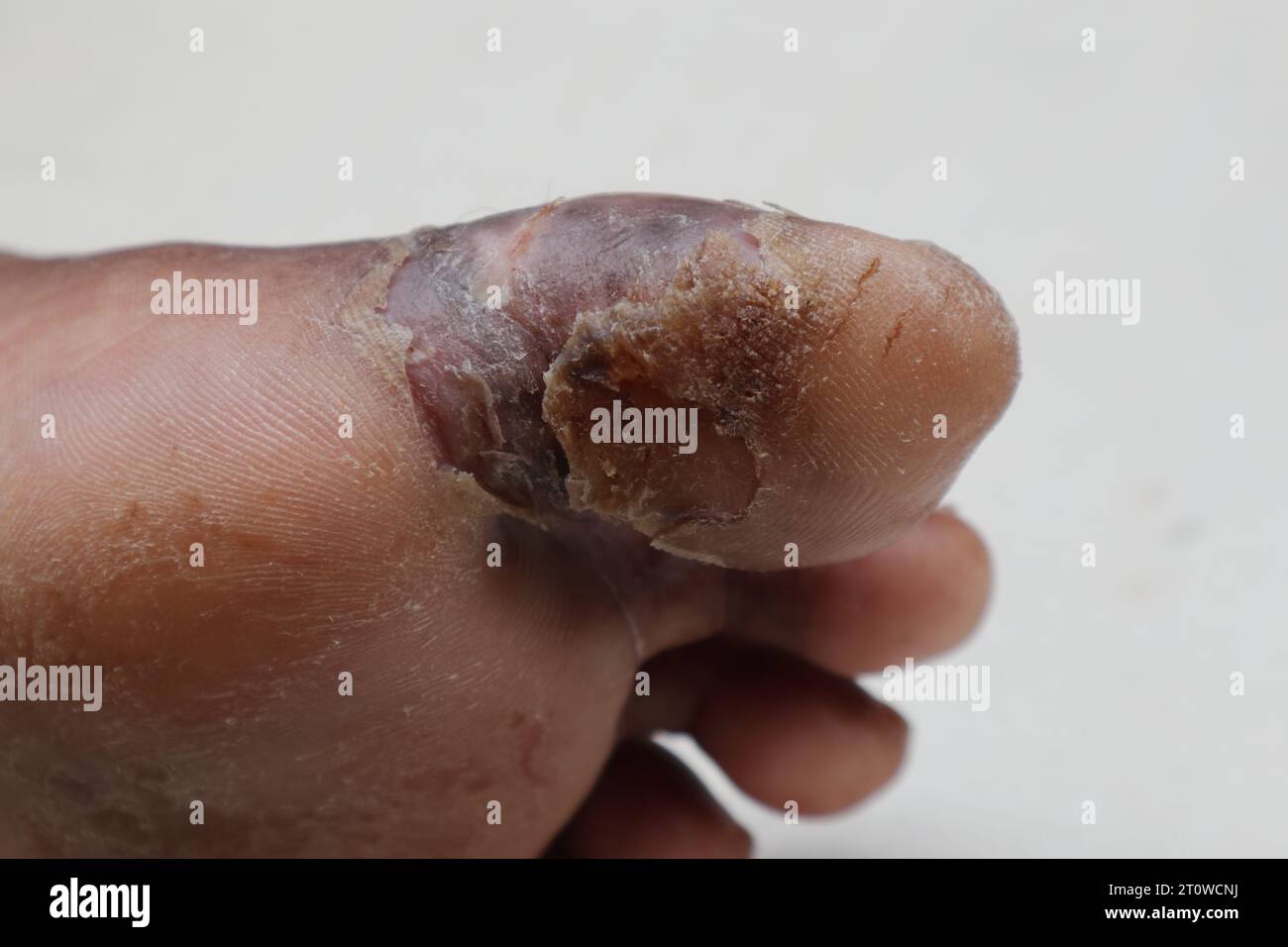 Vista angolare di un'ulcera diabetica del piede sul lato inferiore di un'alluce di una paziente diabetica asiatica, l'ulcera ora sta lentamente guarigendo Foto Stock