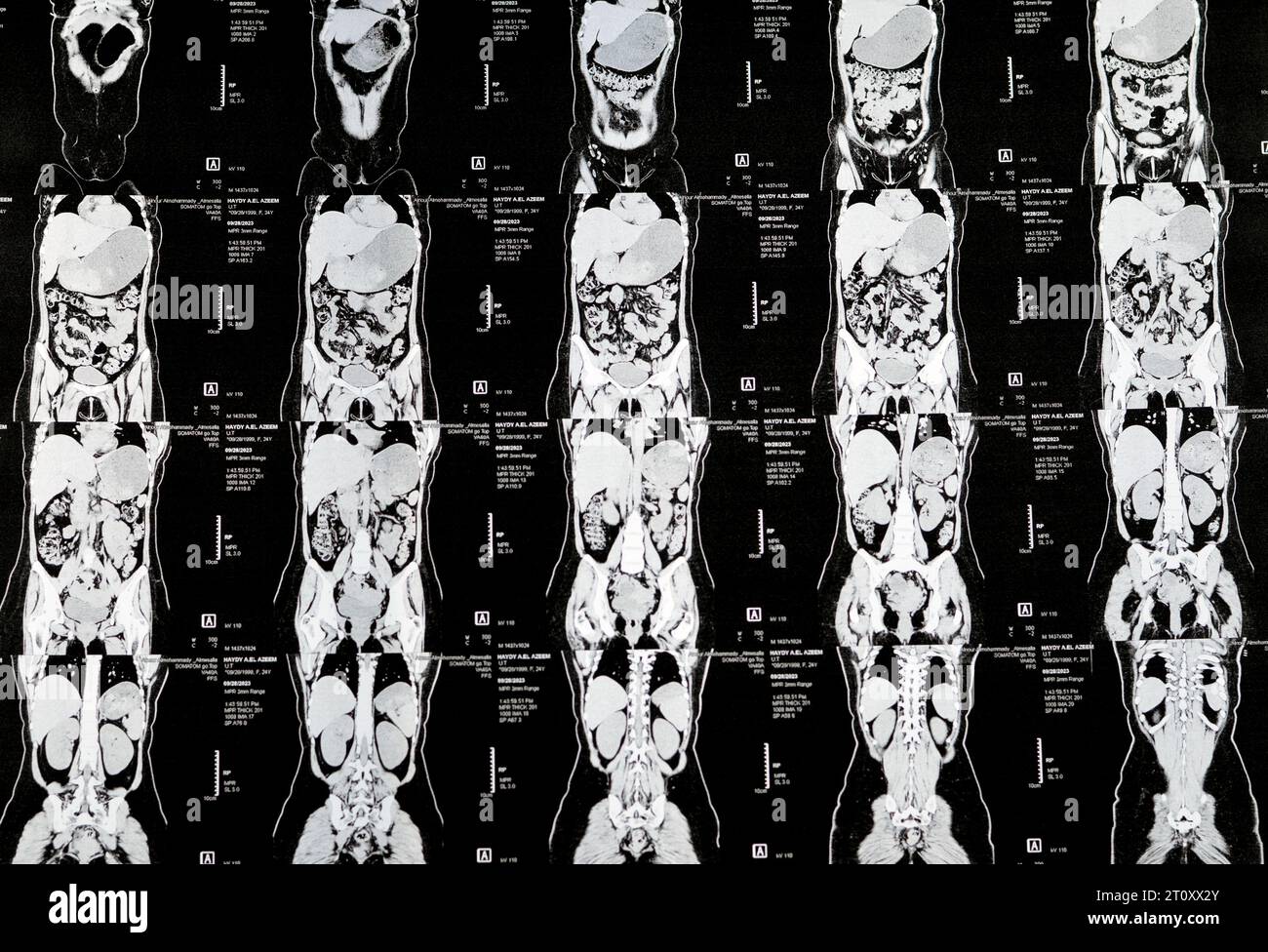Cairo, Egitto, 3 ottobre 2023: La scansione TC multistrato dell'addome e della pelvi mostra cisti ovarica destra 3 x 3 cm, distensione gassosa del colon, nessuna urinaria di dimensioni notevoli Foto Stock