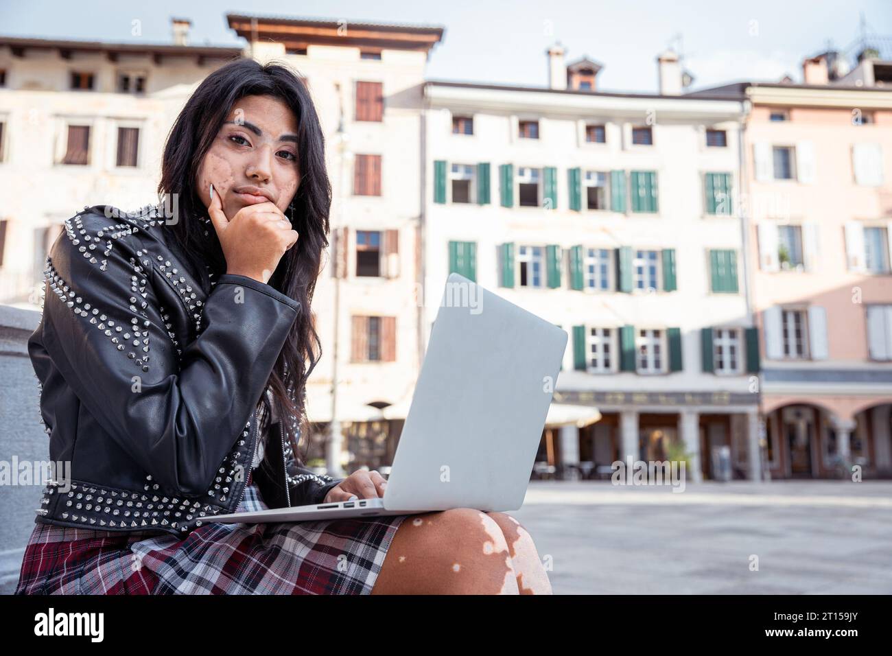 Una ragazza adolescente con vitiligine usa il suo portatile e ha un'espressione premurosa Foto Stock