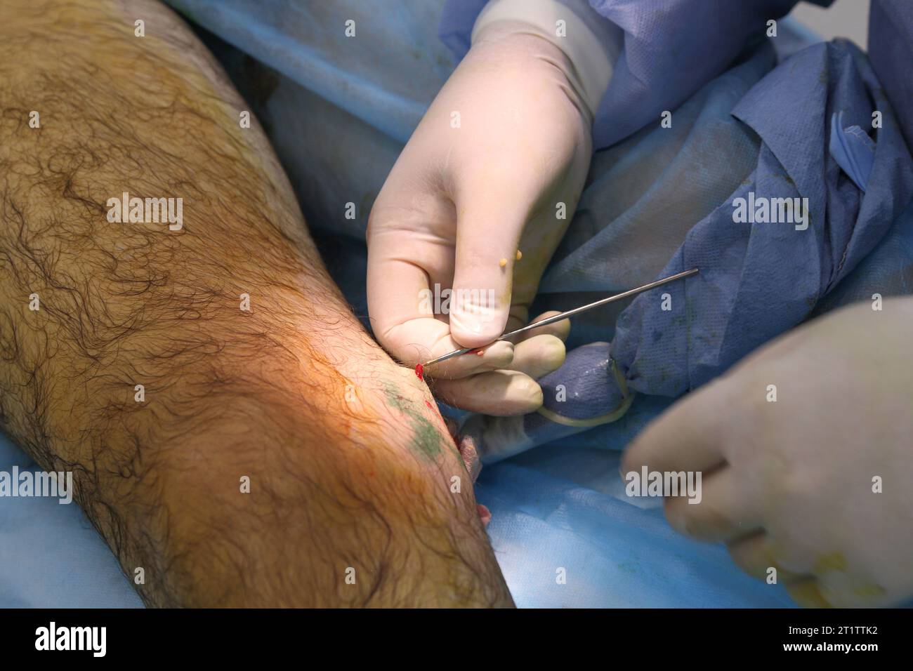 Chirurgia medica per fotocoagulazione laser endovenosa della grande vena safena. Miniphlegectomy. Vena della coagulazione laser endovenosa. Foto Stock