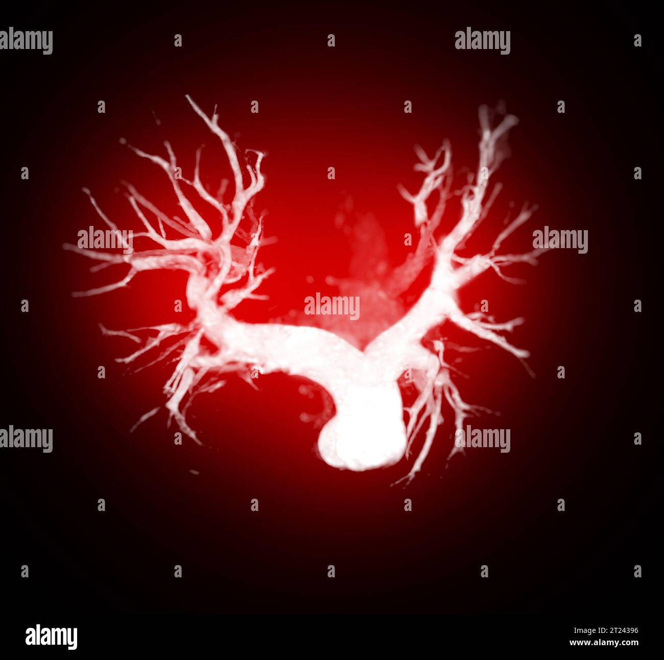 CTA torace o CTPA con mezzo di contrasto rendering 3D per embolia polmonare diagnostica (PE) . Foto Stock