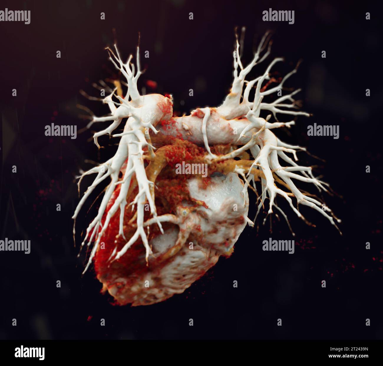 CTA torace o CTPA con mezzo di contrasto rendering 3D per embolia polmonare diagnostica (PE) . Foto Stock