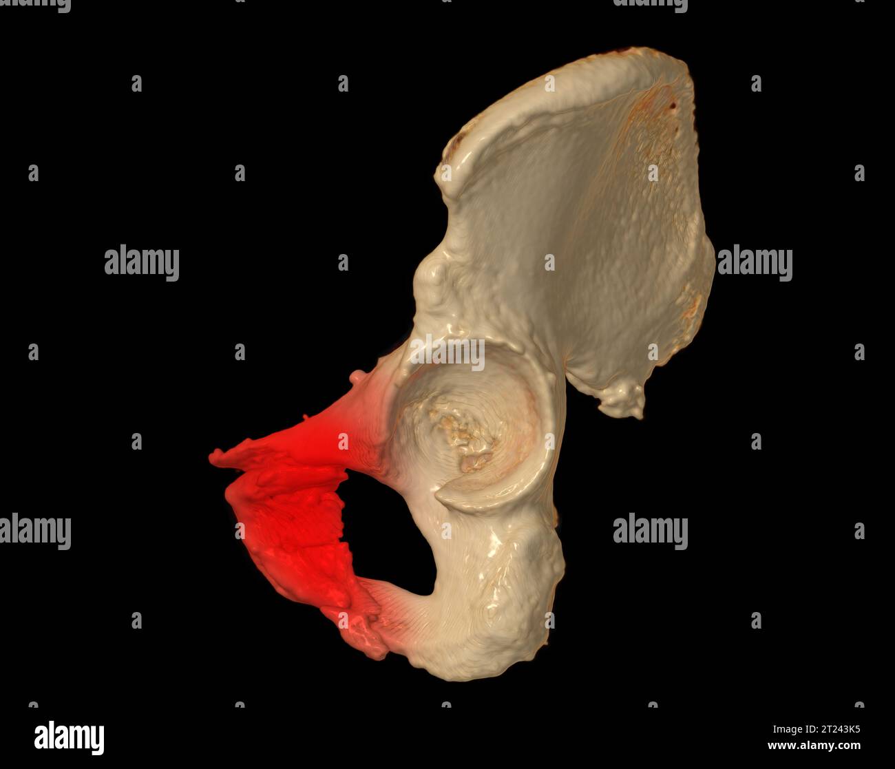 Ischiatica Tuberosità ischiatica immagini e fotografie stock ad alta risoluzione ...