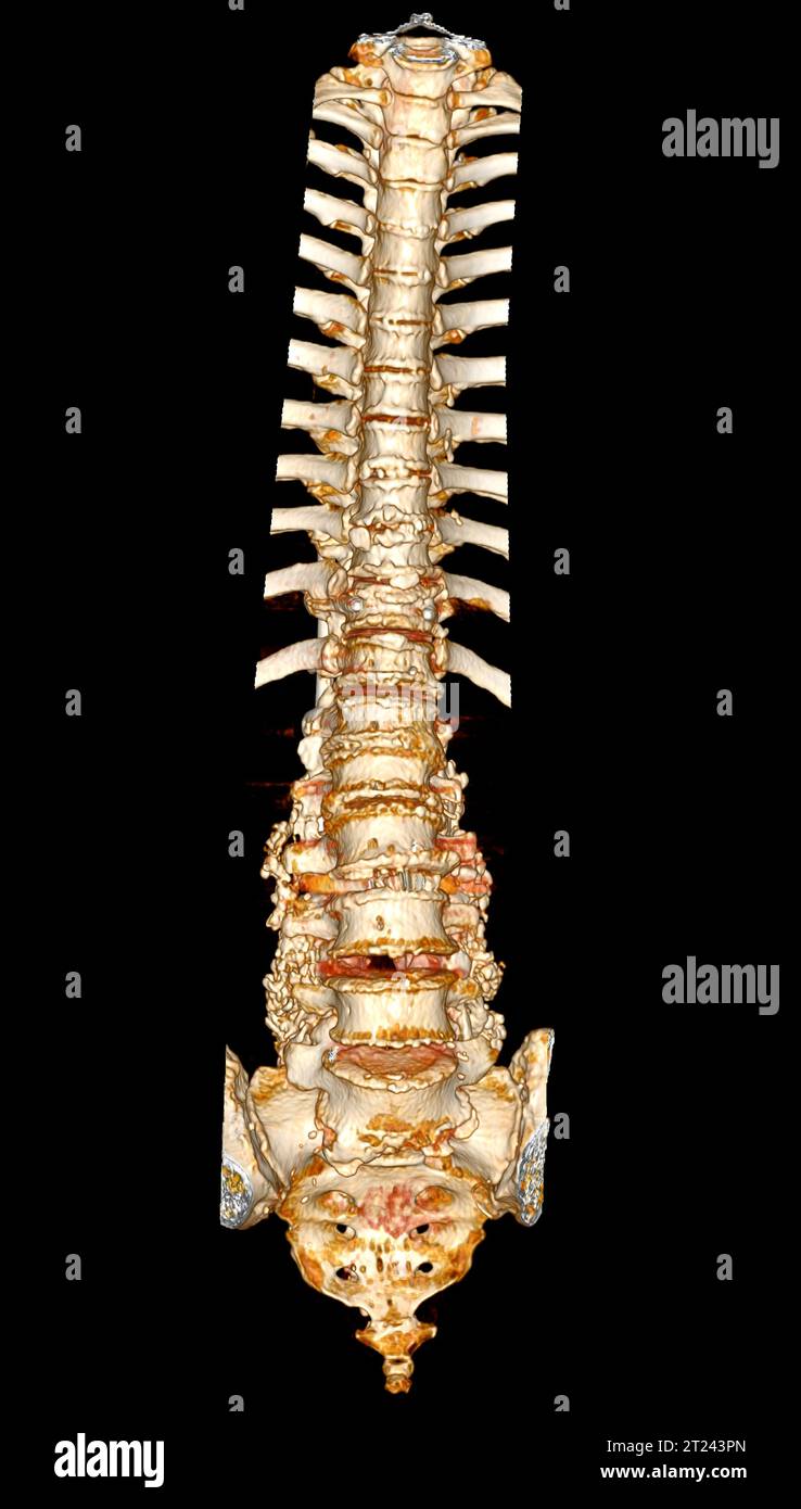 Scansione TC del rendering 3d della colonna toracica e lombare che mostra l'impianto a vite pedicle dopo decompressione chirurgica e fusione spinale. Foto Stock