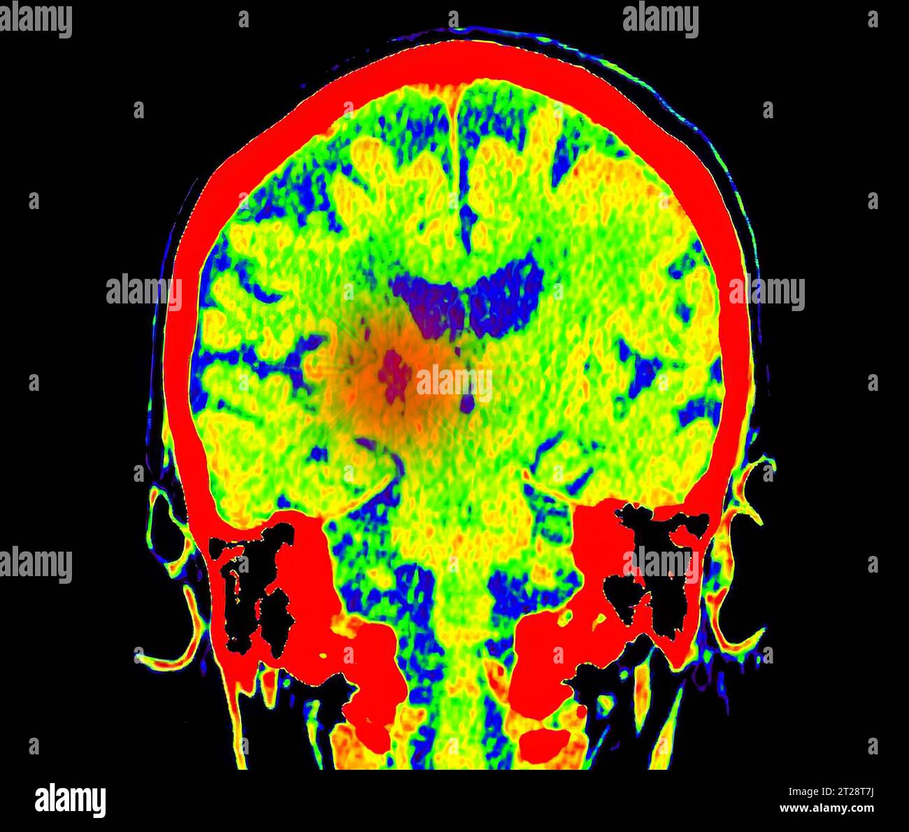 CT Brain Perfusion (perfusione cerebrale TC) o immagine di scansione TC della vista assiale cerebrale che mostra il flusso sanguigno cerebrale sul monitor nell'area dell'ictus. Foto Stock