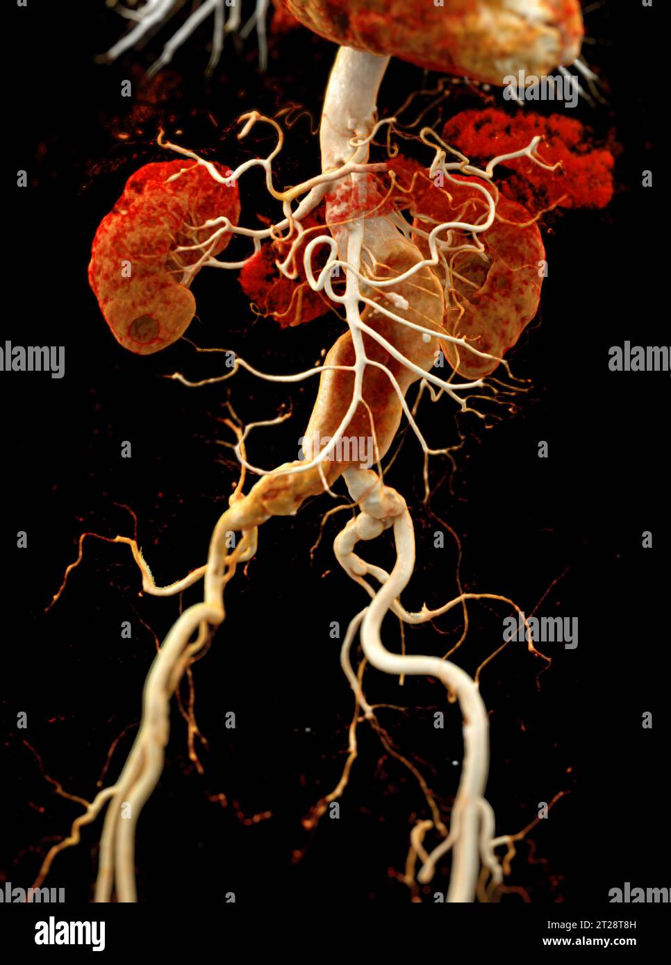 CTA aorta addominale che mostra il rendering 3D della dissezione aortica addominale. Foto Stock