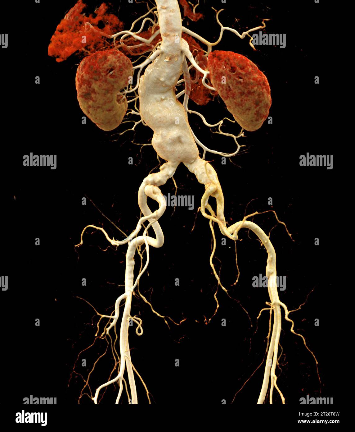 CTA aorta addominale che mostra il rendering 3D della dissezione aortica addominale. Foto Stock