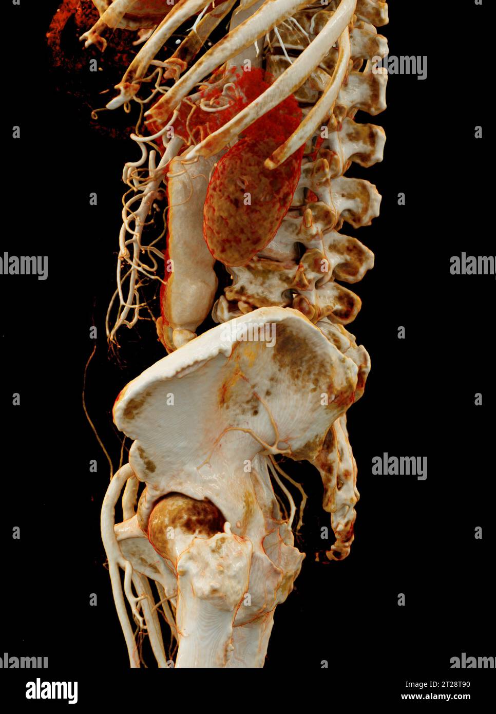 CTA aorta addominale che mostra il rendering 3D della dissezione aortica addominale. Foto Stock