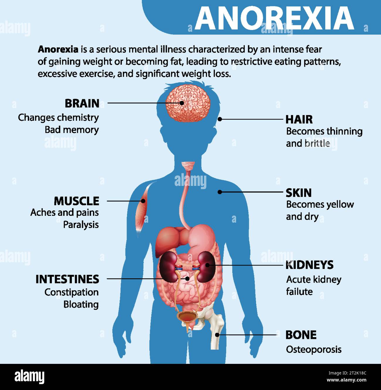 Illustrazione che mostra l'impatto dell'anoressia su varie funzioni del corpo Illustrazione Vettoriale