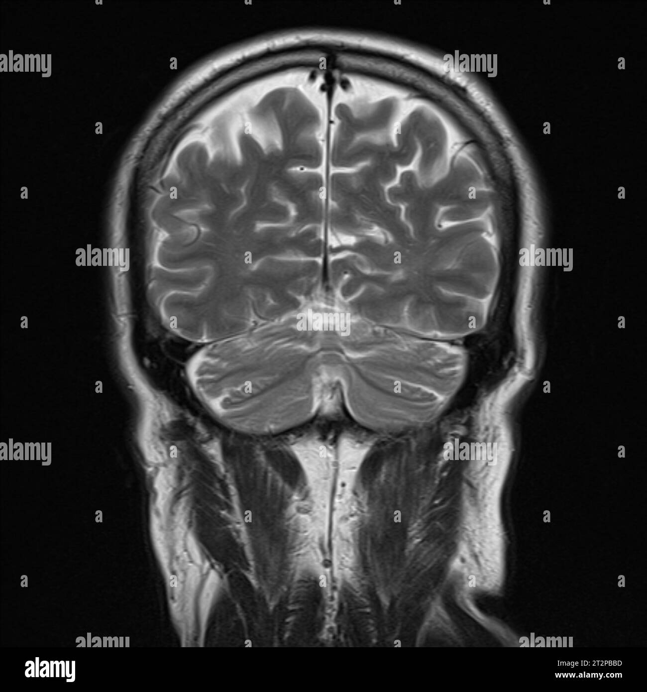 Cervello sano, scansione RM Foto Stock