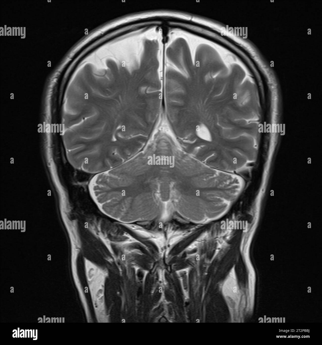 Cervello sano, scansione RM Foto Stock