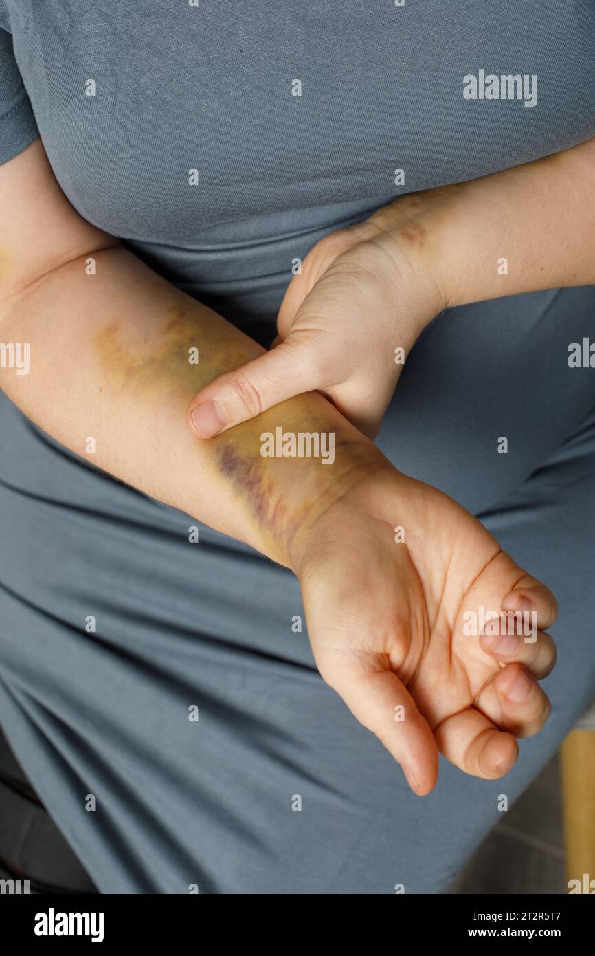 Moman sostiene un braccio con un livido significativo Foto Stock