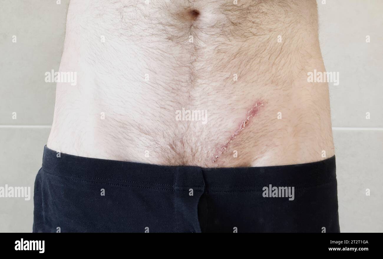 Operazione cicatrice ernia inguinale immagini e fotografie stock ad alta  risoluzione - Alamy