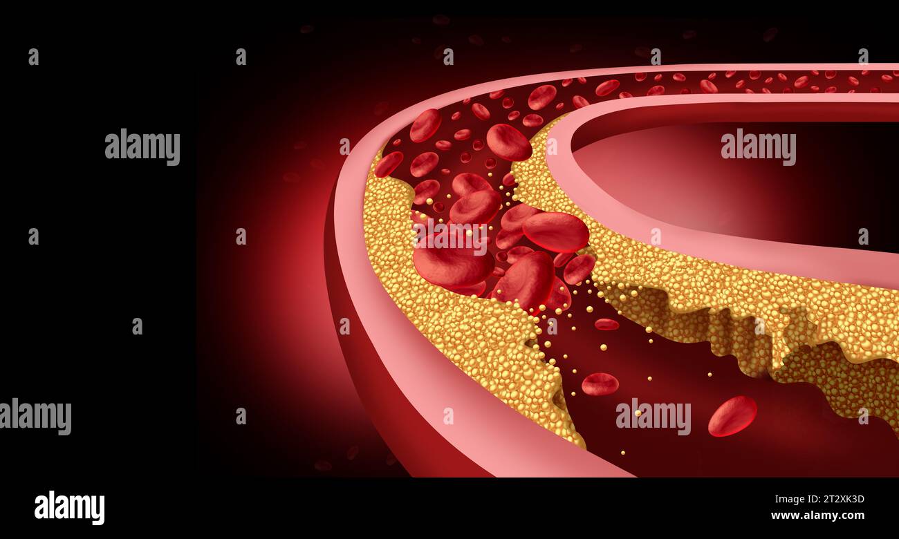 Concetto di arteria umana bloccata e limitato flusso sanguigno nelle arterie un vasi sanguigni come una malattia con colesterolo accumulo di grasso intasamento o blocco cir Foto Stock