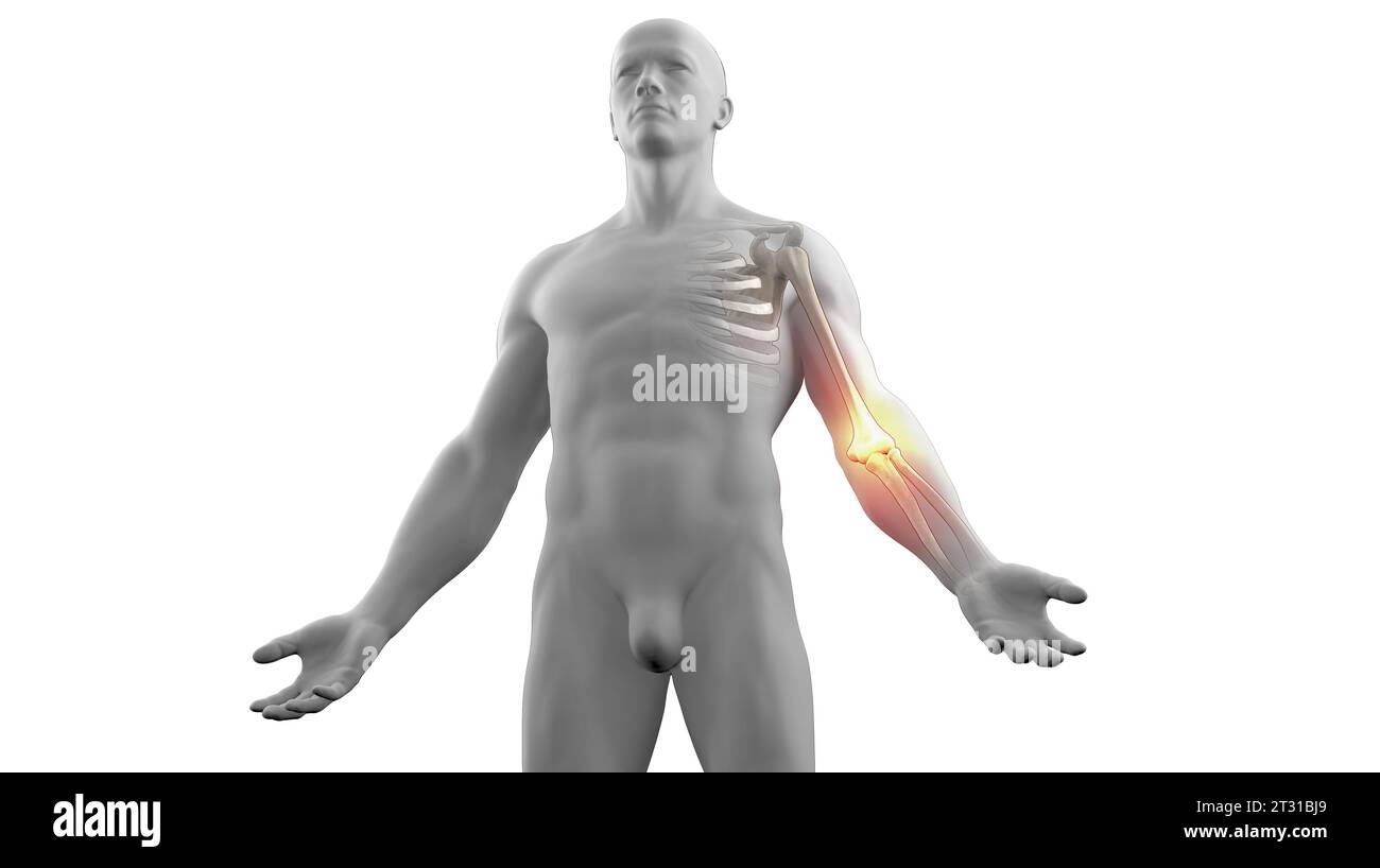 illustrazione in 3d di un'anatomia umana con dolore al gomito Foto Stock