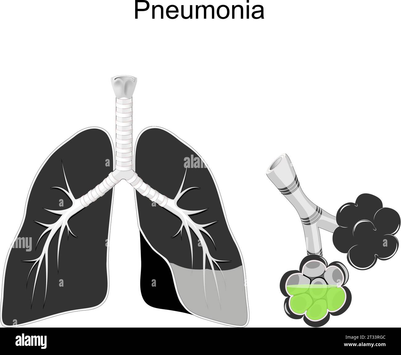 Polmonite. Sezione trasversale di polmoni umani, bronchi e alveoli con liquido verde infezione respiratoria. Illustrazione vettoriale in bianco e nero sulla pneumo Illustrazione Vettoriale