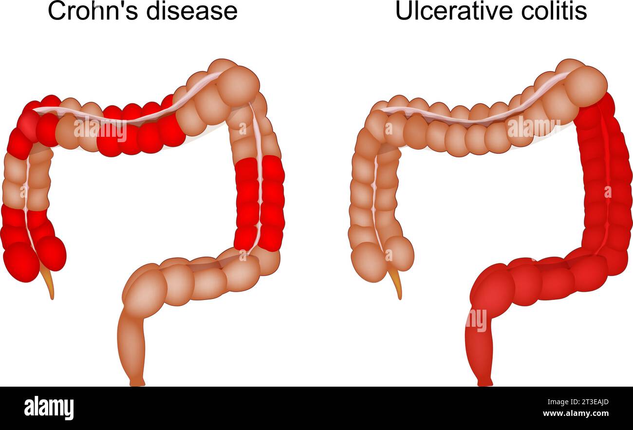 Malattia infiammatoria intestinale. Differenza e confronto dell'intestino crasso dei pazienti con morbo di Crohn e colite ulcerosa. Gastrointestinale i Illustrazione Vettoriale