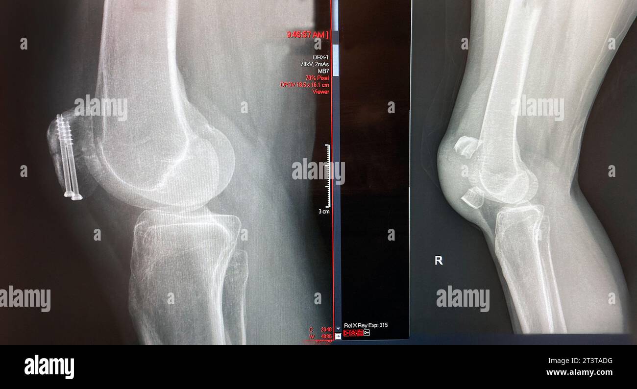 Prima e dopo radiografie mediche del ginocchio della donna media-adulta riparato chirurgicamente Foto Stock