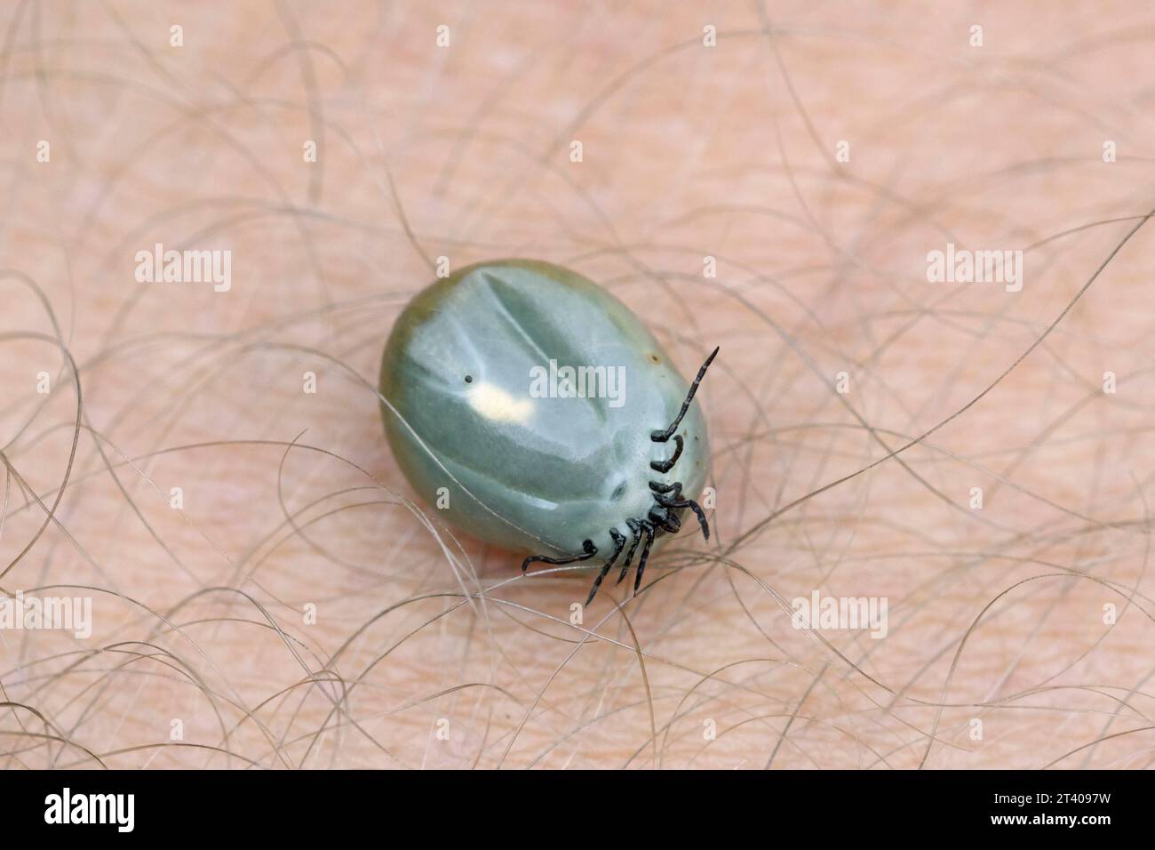 Zecca di fagiolo di ricino (Ixodes ricinus) femmina ingorgo di sangue sulla pelle umana può causare la malattia di Lyme e l'encefalite da zecche Foto Stock