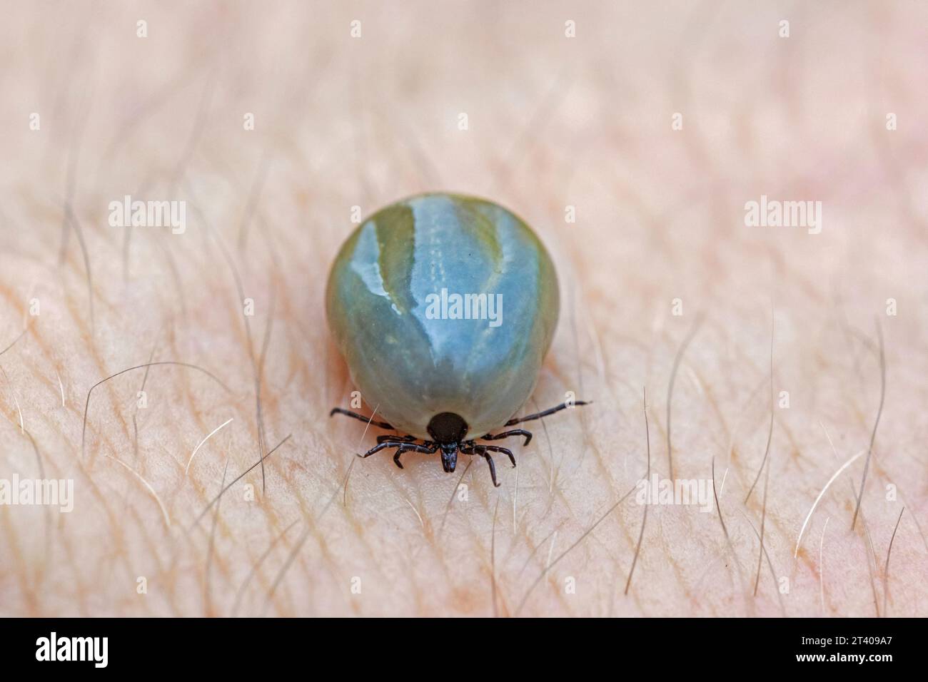 Zecca di fagiolo di ricino (Ixodes ricinus) femmina ingorgo di sangue sulla pelle umana può causare la malattia di Lyme e l'encefalite da zecche Foto Stock