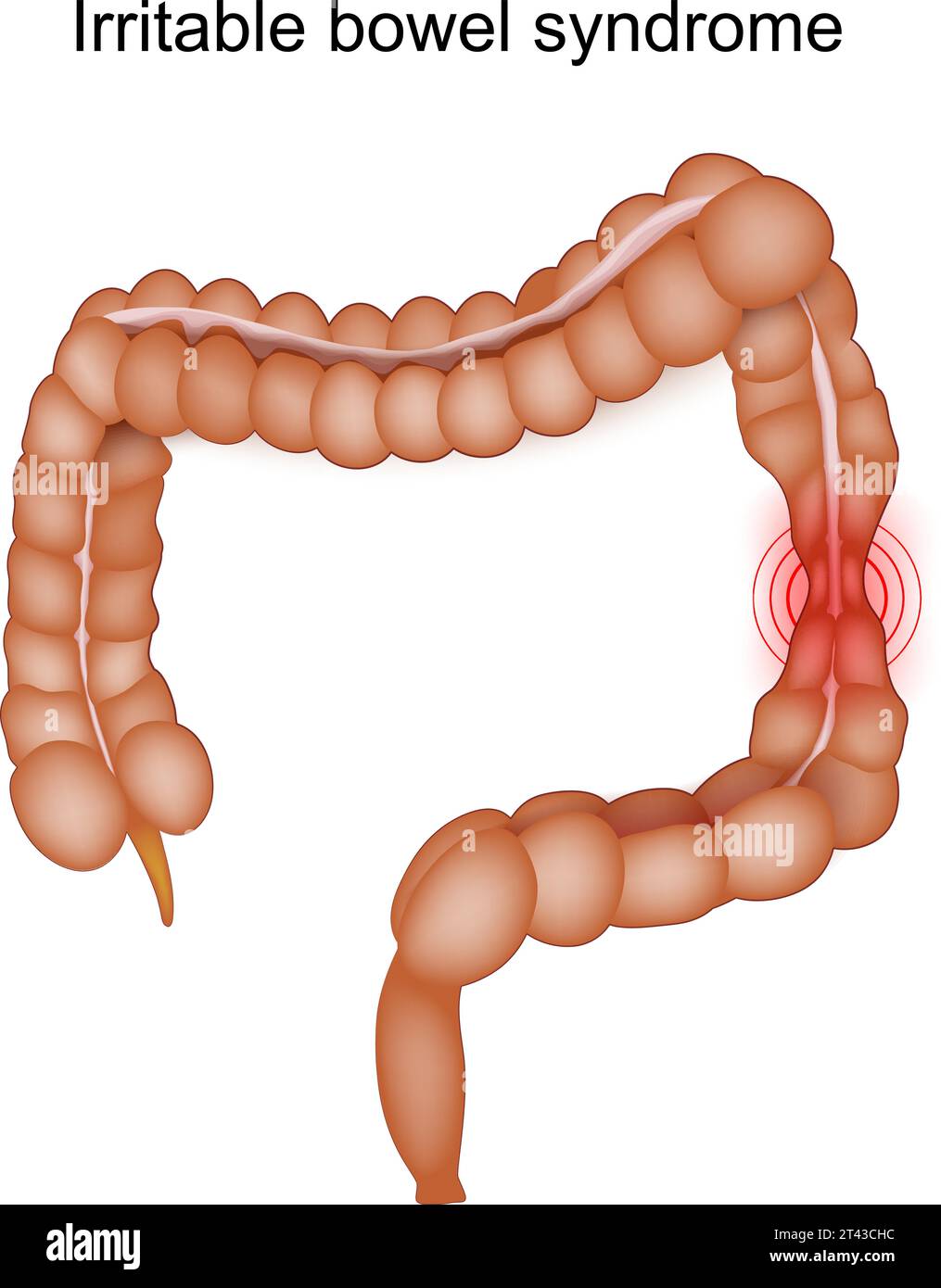Sindrome dell'intestino irritabile. Sintomi IBS. Disturbi gastrointestinali. Colon spastico. Illustrazione vettoriale Illustrazione Vettoriale