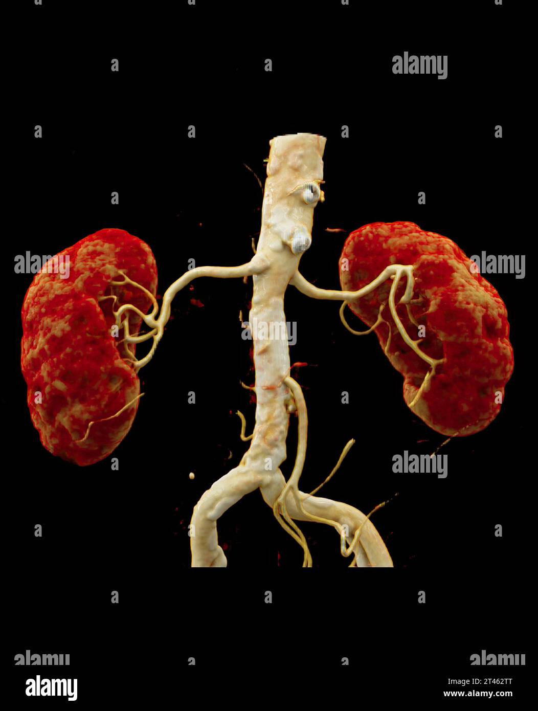 L'arteria renale CTA è una procedura di imaging medico che utilizza scansioni TC per esaminare le arterie renali fornisce immagini dettagliate della supplyina dei vasi sanguigni Foto Stock