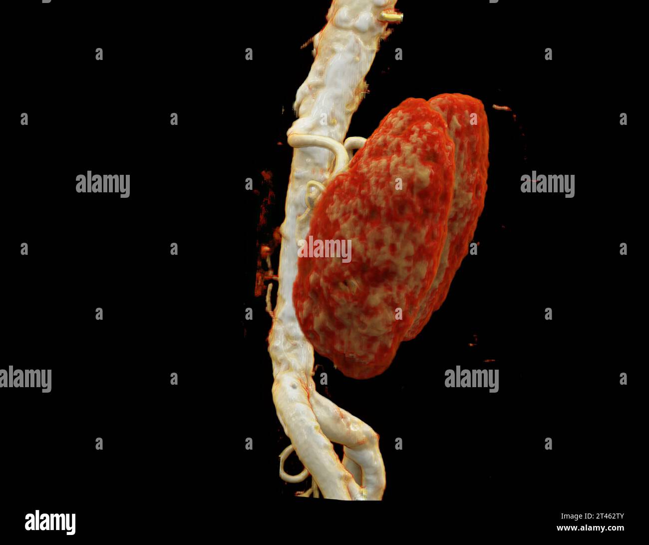 L'arteria renale CTA è una procedura di imaging medico che utilizza scansioni TC per esaminare le arterie renali fornisce immagini dettagliate della supplyina dei vasi sanguigni Foto Stock