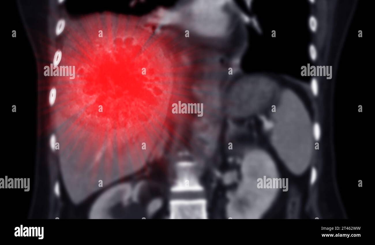 CT vista coronale dell'addome superiore che mostra DDX è HCC atipico o carcinoma epatocellulare. Foto Stock